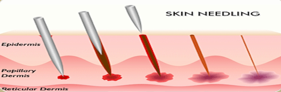 Image result for skin needling