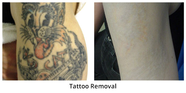 How to safely get a tattoo removed - CNN.com