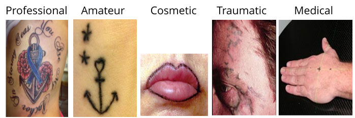 Tattoo Removal Service in Redding CA | SMWC